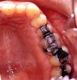 Amalgam, das am häufigsten verwendete Füllungsmaterial, kann zu regelrechten Vergiftungserscheinungen führen.