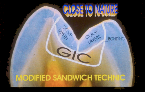 Modified Sandwich Technique